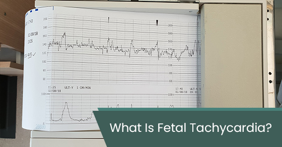 What is fetal tachycardia?